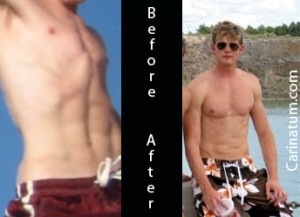 Pectus-Carinatum before and after